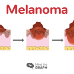 melanoma